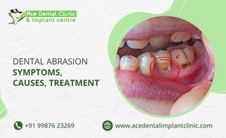 Dental Abrasion – Symptoms, Causes, Treatment